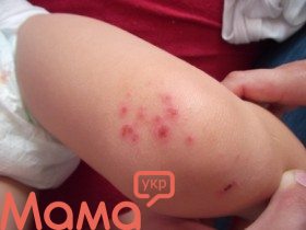 Атопический дерматит у детей: контроль заболевания возможен