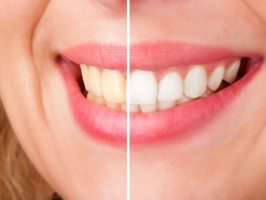 Отбеливание зубов в домашних условиях – 6 проверенных способов 