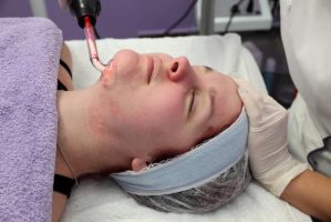 Салонные процедуры против пигментных пятен на лице 