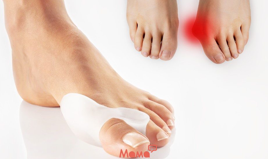 Большой палец выходит из строя: что нужно знать о халюкс вальгусе