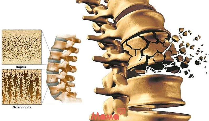 Чому виникає остеопороз та як йому запобігти