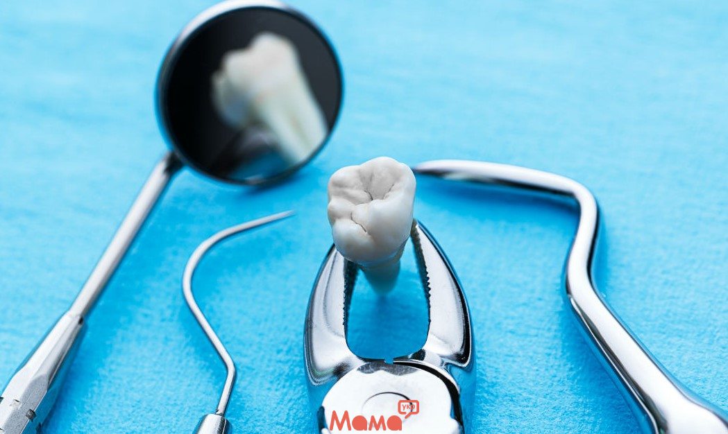Видалення зубів — показання та протипоказання